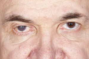 close up of the senile cataract during eye examination