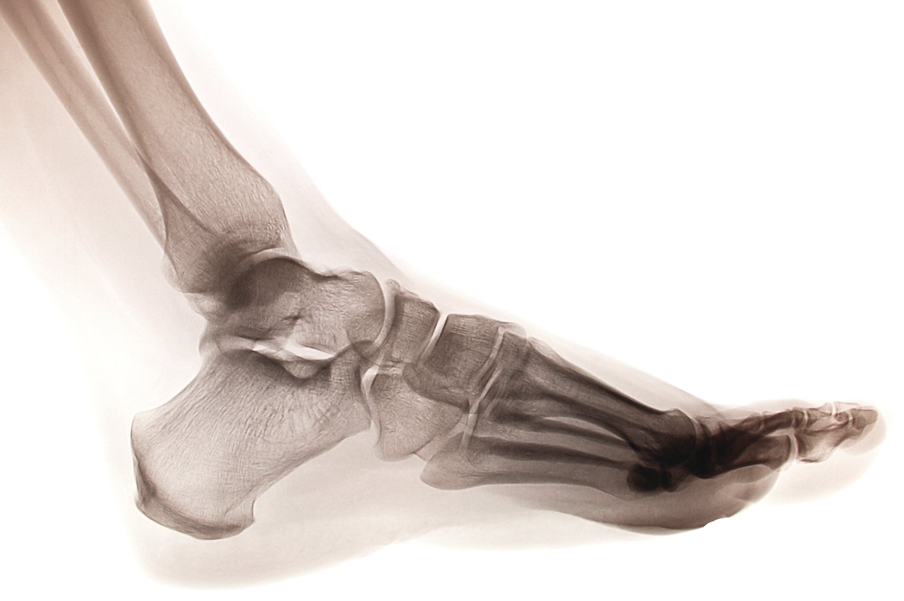 Голеностопный сустав относится к суставам. Кости голеностопного сустава анатомия. Пяточная кость анатомия человека. Скелет голеностопного сустава.